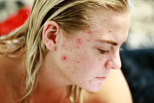 ACNE Um Guia Completo para Combater Espinhas e Ter uma Pele Saudável